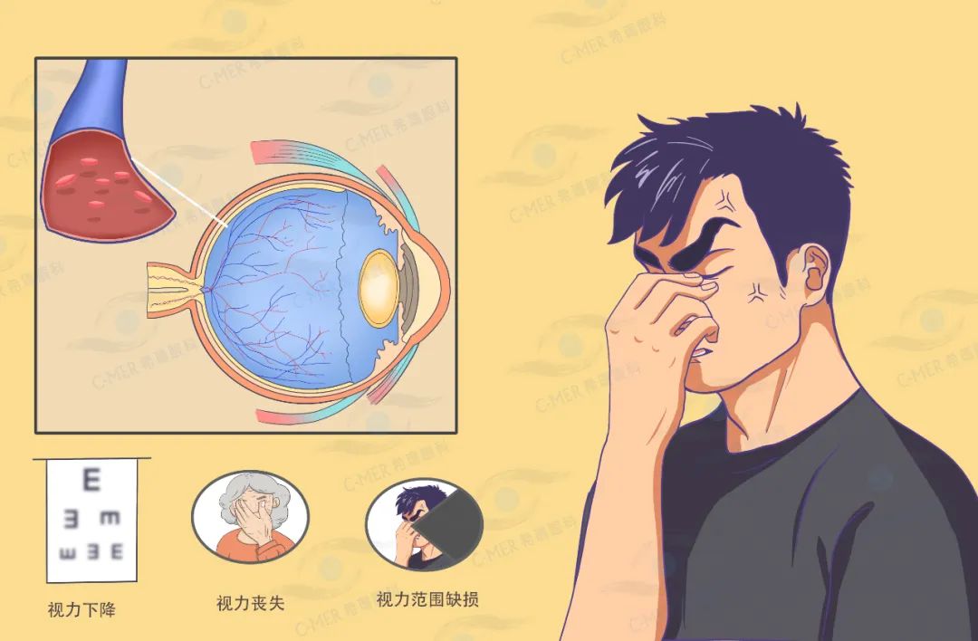 眼中風是什么癥狀,眼中風是怎么引起的 眼中風是什么癥狀,眼中風是怎么引起的