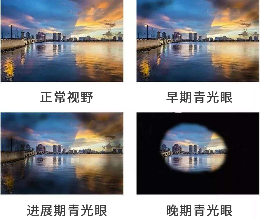 青光眼不同時(shí)期的示意圖