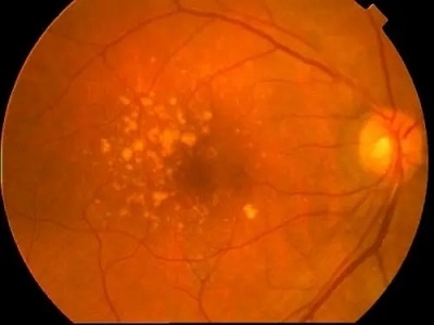 近視,近視定期眼底檢查 近視,近視定期眼底檢查