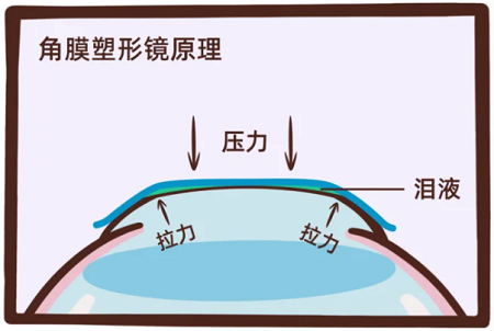 珠海角膜塑形鏡,角膜塑形鏡原理,配戴角膜塑形鏡應該注意什么 珠海角膜塑形鏡,角膜塑形鏡原理,配戴角膜塑形鏡應該注意什么