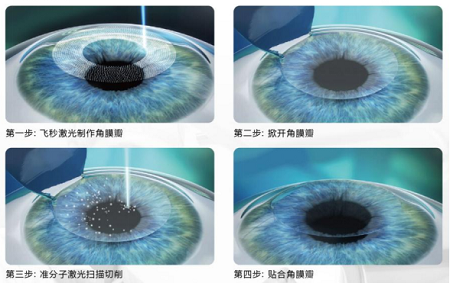 近視眼手術(shù)適合人群,近視手術(shù)的要求有哪些,哪些人不適合激光近視手術(shù) 近視眼手術(shù)適合人群,近視手術(shù)的要求有哪些,哪些人不適合激光近視手術(shù)