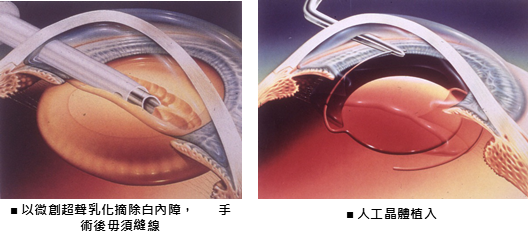 白內障手術.png