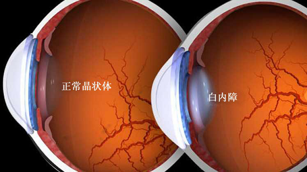 白內(nèi)障,青光眼,白內(nèi)障手術(shù),珠海?，斞劭漆t(yī)院