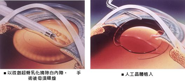 白內(nèi)障,青光眼,白內(nèi)障手術(shù),珠海?，斞劭漆t(yī)院