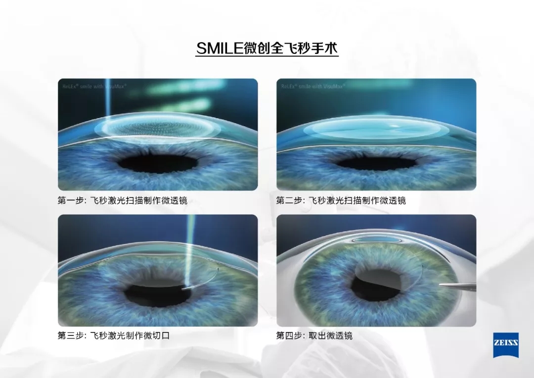近視手術(shù),激光矯正,晶體植入式,珠海?，斞劭漆t(yī)