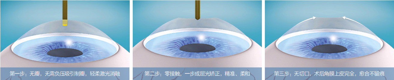 近視手術(shù),激光矯正,晶體植入式,珠海?，斞劭漆t(yī)