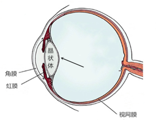 白內(nèi)障,視力模糊,色覺異常,老花眼,單眼復視,珠海