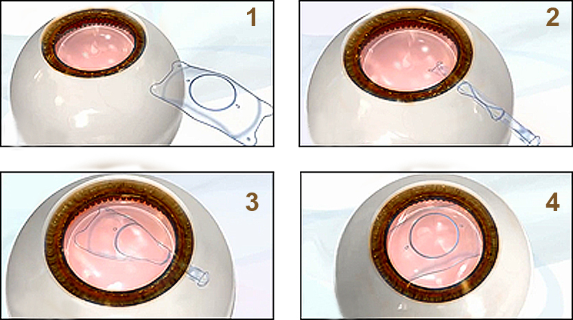 ICL晶體植入手術(shù),全飛秒激光手術(shù),近視手術(shù),珠海?，斞劭漆t(yī)院