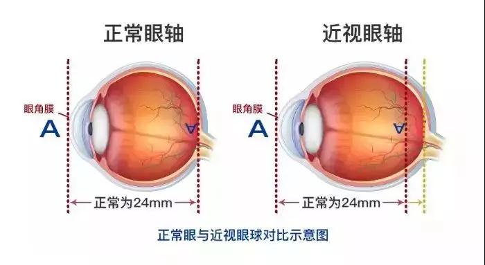 近視,小兒眼病,珠海?，斞劭漆t(yī)院