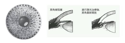 急性青光眼,前房穿刺,眼科專科醫(yī)院