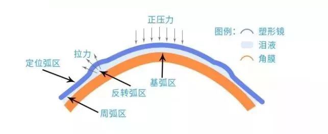 青少年近視,兒童近視,OK鏡,珠海?，斞劭漆t(yī)院
