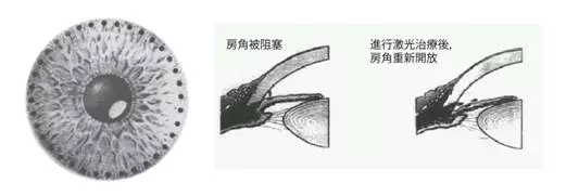 干眼癥,急性青光眼,眼中風(fēng),珠海?，斞劭漆t(yī)院
