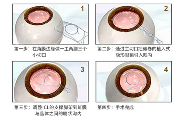 近視,治療近視，近視手術(shù)，珠海希瑪眼科醫(yī)院