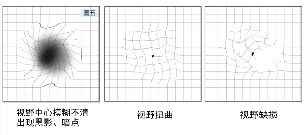 高度近視,屈光,近視,珠海希瑪眼科