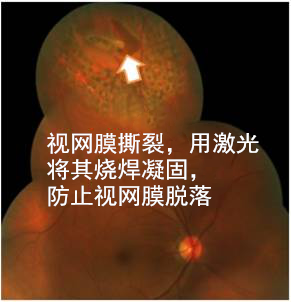 飛蚊,病癥,玻璃體,視網(wǎng)膜,珠海?，斞劭漆t(yī)院