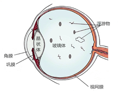 飛蚊,病癥,玻璃體,視網(wǎng)膜,珠海?，斞劭漆t(yī)院