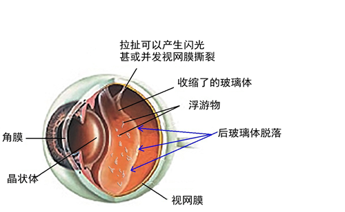飛蚊,病癥,玻璃體,視網(wǎng)膜,珠海?，斞劭漆t(yī)院