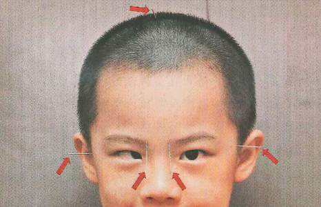 內(nèi)斜視,屈光,斜視治療,珠海?，斞劭漆t(yī)院