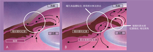 白內(nèi)障,黃斑轉(zhuǎn)性,青光眼,珠海希瑪眼科醫(yī)院