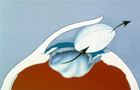 白內(nèi)障,白內(nèi)障手術(shù),飛秒白內(nèi)障手術(shù),珠海?，斞劭漆t(yī)院