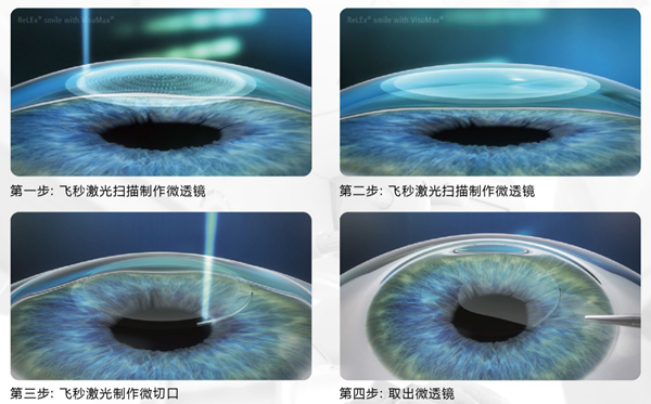 屈光手術,近視手術,近視矯正,珠海?，斞劭漆t(yī)院