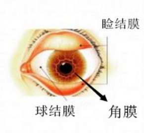 角膜炎,角膜鱗狀,角膜穿孔,珠海希瑪眼科醫(yī)院