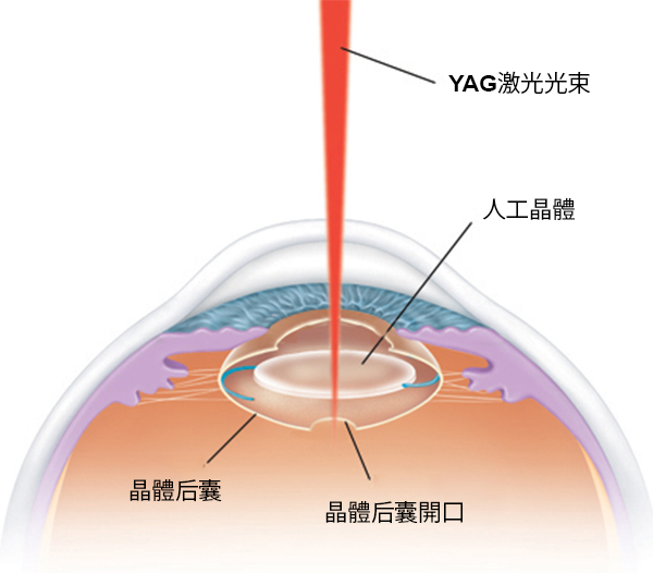 白內(nèi)障,白內(nèi)障手術(shù),珠海?，斞劭漆t(yī)院