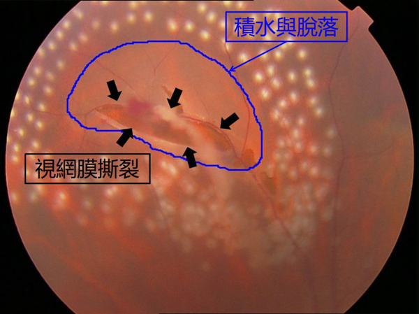 飛蚊癥,珠海治療飛蚊癥,珠海?，斞劭漆t(yī)院