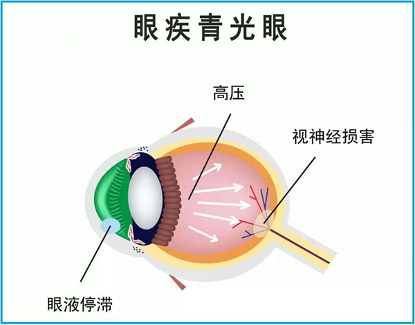 青光眼,珠海治療青光眼,珠海?，斞劭漆t(yī)院