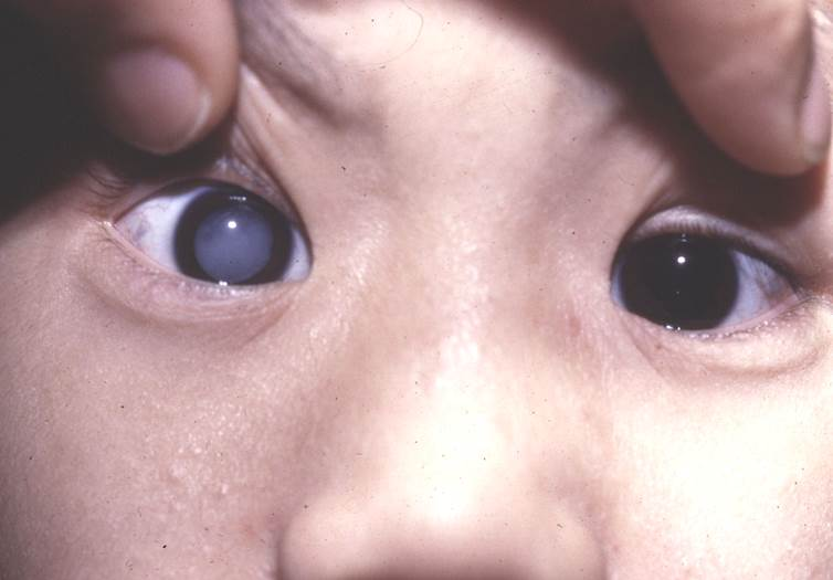白內(nèi)障,白內(nèi)障手術(shù),珠海白內(nèi)障,珠海?，斞劭漆t(yī)