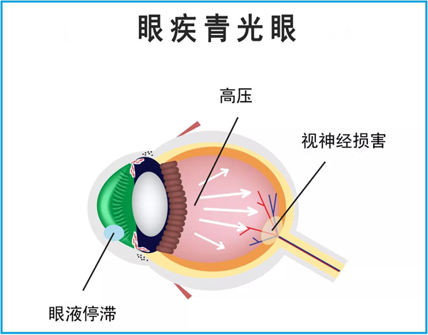 青光眼,繼發(fā)型青光眼,珠海希瑪眼科醫(yī)院