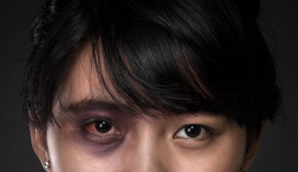 眼外傷,眼球穿孔,珠海?，斞劭漆t(yī)院
