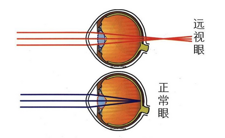 散光,散光測(cè)試,珠海?，斞劭漆t(yī)院