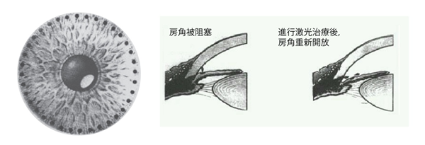 白內(nèi)障,白內(nèi)障手術(shù),珠海?，斞劭漆t(yī)院