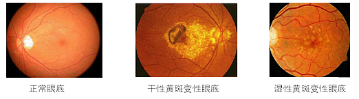 黃斑變性,黃斑水腫,珠海?，斞劭漆t(yī)院