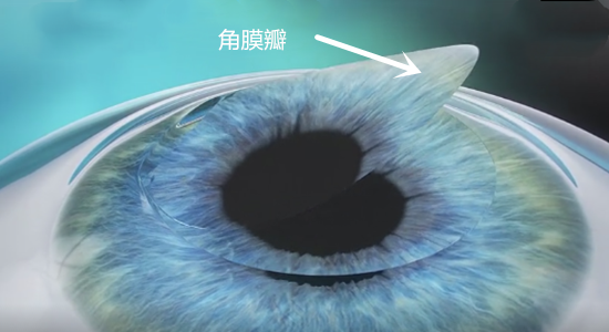 近視,近視手術,珠海希瑪眼科醫(yī)院