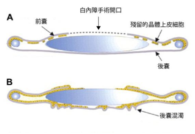 白內(nèi)障,白內(nèi)障手術(shù),珠海?，斞劭漆t(yī)院