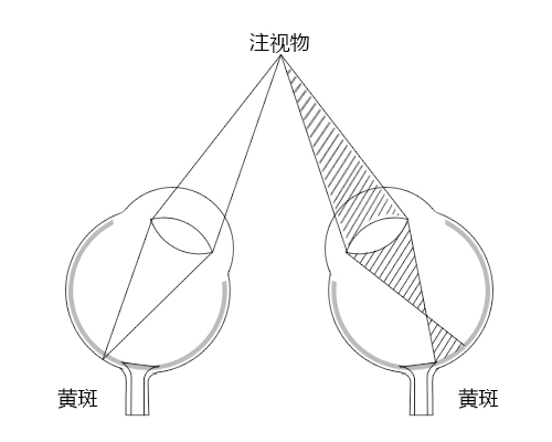 弱視,小兒弱視,治療弱視,珠海?，斞劭漆t(yī)院