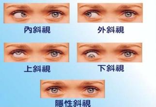 弱視,小兒弱視,治療弱視,珠海?，斞劭漆t(yī)院