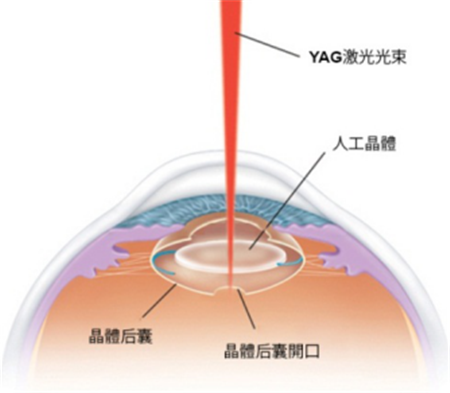 白內(nèi)障,白內(nèi)障手術(shù),珠海?，斞劭漆t(yī)院