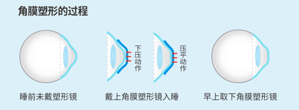 昆明配ok鏡的醫(yī)院有哪些？