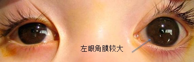青光眼,先天性青光眼,青光眼治療,珠海?，斄猪槼毖劭漆t(yī)院