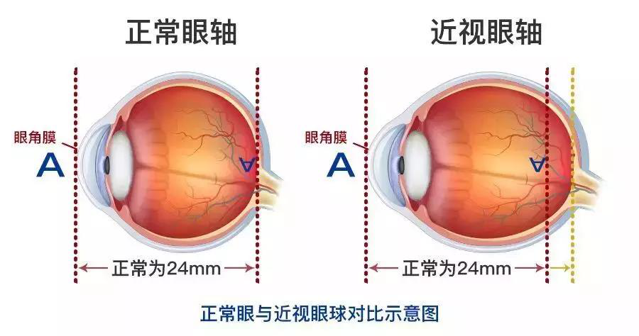 近視,珠海治療近視哪家好,珠海希瑪林順潮眼科醫(yī)院