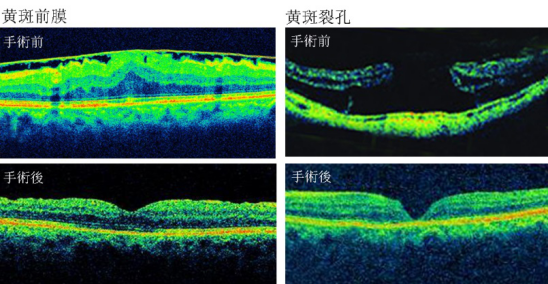 近視,珠海治療近視哪家好,珠海?，斄猪槼毖劭漆t(yī)院