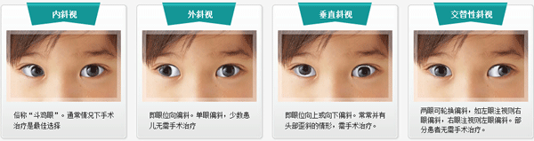 小兒斜視,小兒弱視,治療斜視,珠海?，斄猪槼毖劭漆t(yī)院