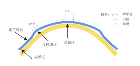 OK鏡對(duì)眼睛傷害大嗎？