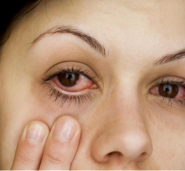 角膜炎,珠海治療角膜炎醫(yī)院,珠海?，斄猪槼毖劭漆t(yī)院