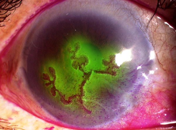 角膜炎,珠海治療角膜炎醫(yī)院,珠海?，斄猪槼毖劭漆t(yī)院