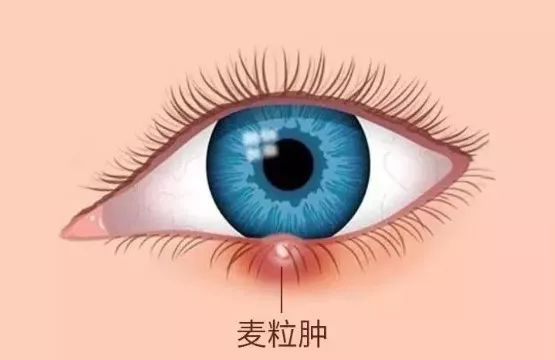 麥粒腫,得了麥粒腫怎么辦,珠海麥粒腫醫(yī)院 麥粒腫,得了麥粒腫怎么辦,珠海麥粒腫醫(yī)院