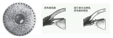 急性青光眼發(fā)作的癥狀有哪些？